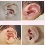 先天性小耳畸形会不会影响听力？